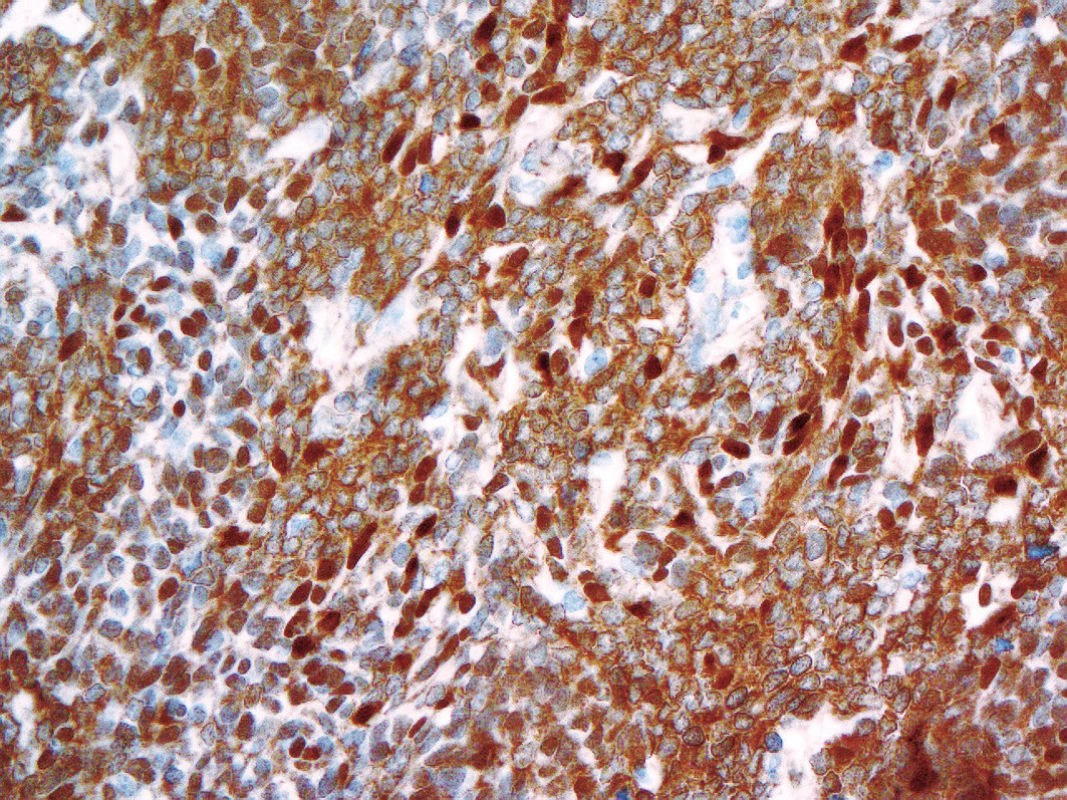 Kolísající jaderná imunoexprese beta-cateninu u WNT- aktivovaného meduloblastomus prokázanou mutací v exonu 3 genu &lt;i&gt;CTNNB1&lt;/i&gt; (400x).