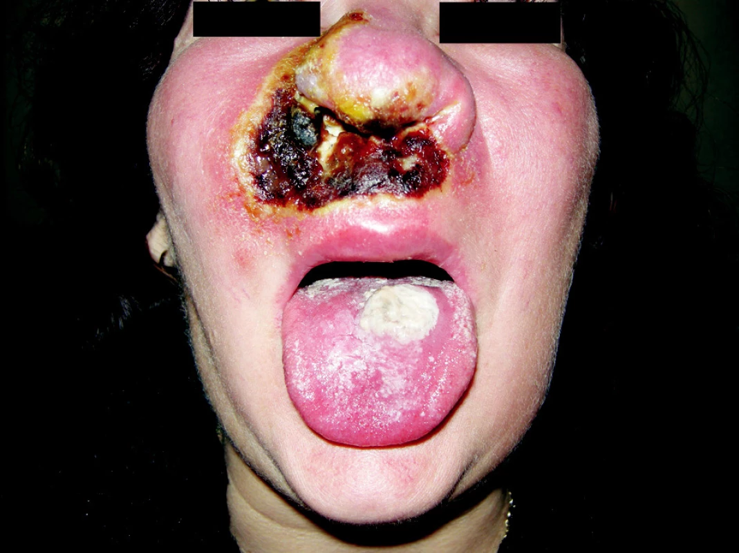 Pyoderma gangraenosum obličeje 6 týdnů po vzniku prvního defektu na tváři.