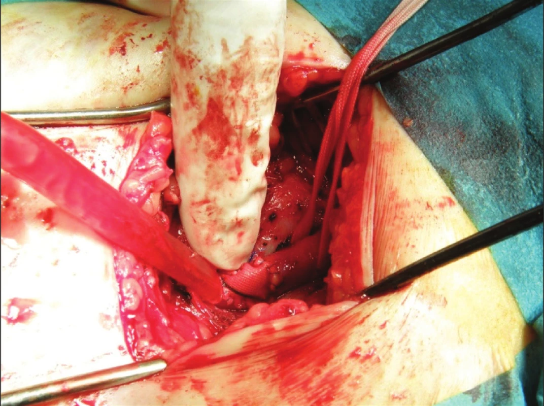 Plastika stehenní tepny
Fig. 3. Femoral artery surgery