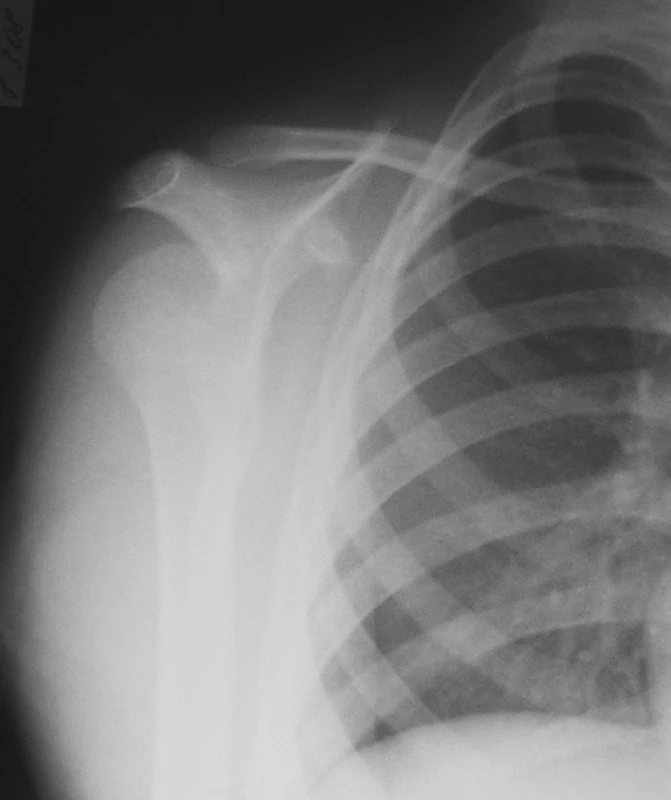 1. PA rtg snímok ramena
Fig. 1. PA x-ray view of the shoulder