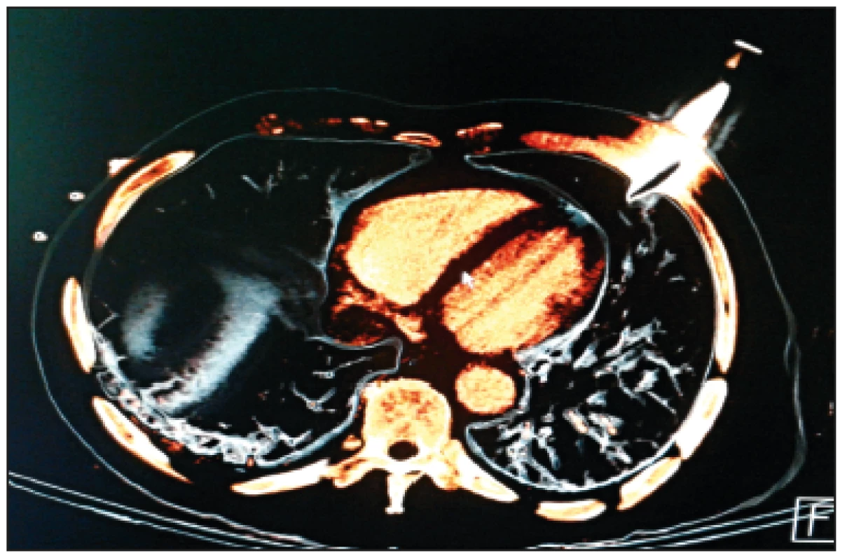 Zobrazení VRT při CT vyšetření