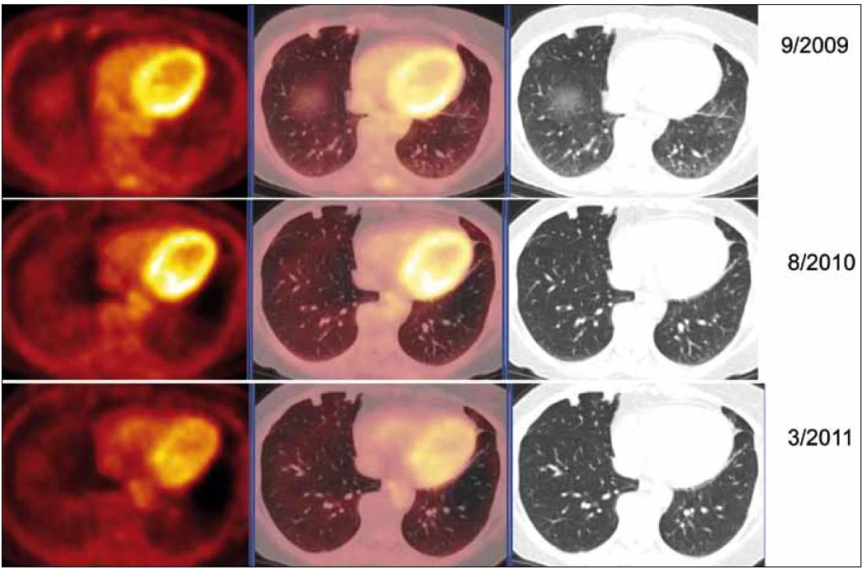 PET-CT zobrazení jednotlivých plicních ložisek v čase (září roku 2009, srpen roku 2010, březen roku 2011), axiální řezy, ve sloupcích zleva PET, PET/CT a CT. PET obraz je v barevné škále „Hot Body“, řazeno odshora. Dvě denzní subpleurálně uložené léze ventrálně v S5 vpravo bazálně. V čase je vidět pokles metabolické aktivity (PET řezy, iniciálně SUV&lt;sub&gt;max&lt;/sub&gt; 1,82 – laterálnější a 1,8 mediálnější), zatímco velikost ložisek je přibližně stacionární (CT řezy, 11 × 9 laterálně a 8 × 9 mm mediálně).