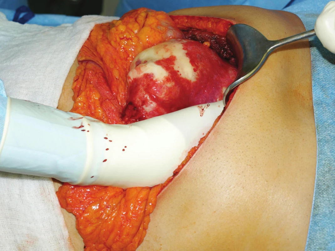 Peroperační záběr postižení levého laloku jaterního
Fig. 1: Perioperative image of the left hepatic lobe involvement