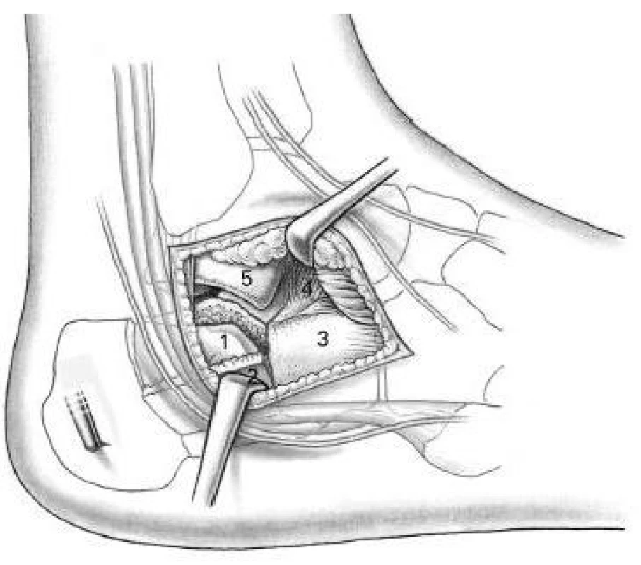 Laterální subtalární přístup dle Webera
1–posterolaterální kloubní fragment, 2–fragment laterální stěny, 3–processus anterior patní kosti, 4–ligamentum interosseum, 5–processus lateralis tali