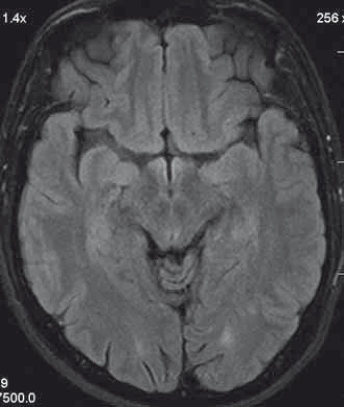 Patient´s head MRI.
A T2 hyperintensive demyelinating lesion in the left occcipitally lobe.