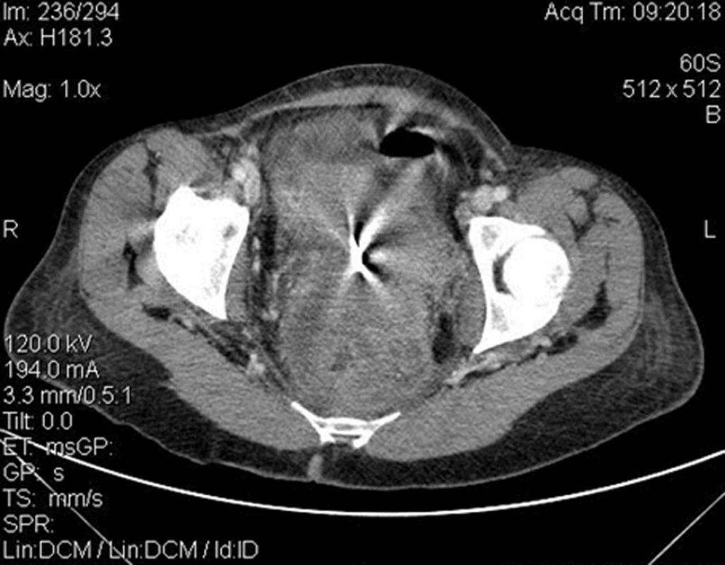 CT obraz tumorózní masy malé pánve
Fig. 3: CT image of pelvic tumour mass