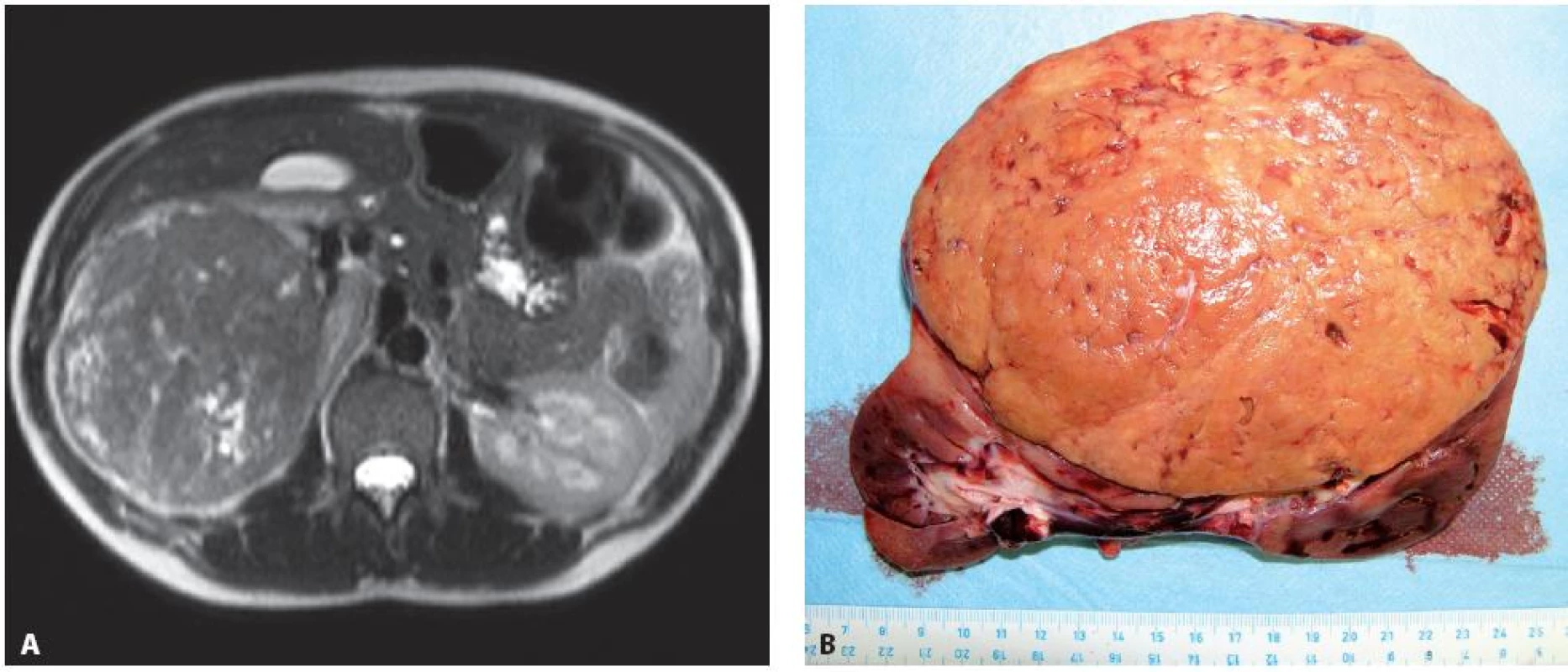 Případ 24leté ženy ve 4. měsíci gravidity, dle MRI. A – objemný tumorem pravé ledviny T3aN0M0 (11), provedena transperitoneální nefrektomie vpravo, B – disekovaný operační preparát), následný spontánní porod v řádném termínu. Šest let od operace bez recidivy tumoru.
Fig. 4. Twenty four year old woman, 4 months pregnant. A – a large tumour of the right kidney T3aN0M0 (11) seen on MRI. Transperitoneal nephrectomy performed, B – surgical specimen). Patient delivered a healthy baby. Patient is without recurrence of disease on the 6 years follow-up examination.