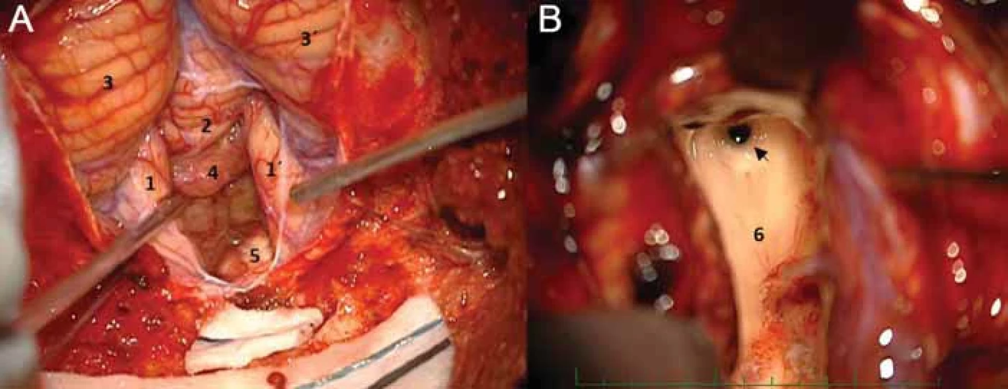 Operace plexus papillomu IV. komory z telovelárního přístupu – (A) vallecula cerebelli vyplněná tumorem; (B) pohled do akveductus Sylvii po dokončení resekce s náletem tumoru na spodině IV. komory.