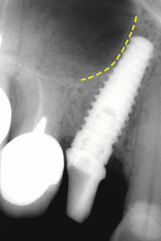 Tilted implantát v „retrocanine bone triangle“. Ventrální ohraničení sinus maxillaris je zvýrazněno