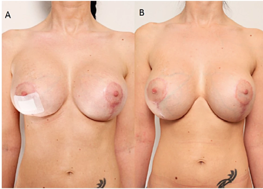 Patient 2 weeks (a) and twelve months (b) after a revision surgery