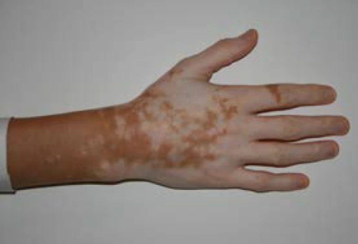 Ruce pacienta s Addisonovou chorobou, resp. autoimunitním polyglandulárním syndromem 2. typu s viditelnými hyperpigmentacemi kontrastujícími s vitiligem (z archivu autora)