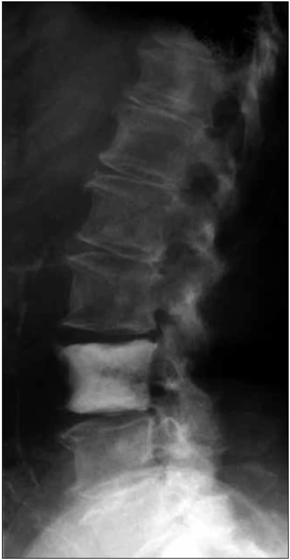 Boční RTG snímek páteře u pacientky s osteosklerotickým mnohočetným myelomem a POEMS syndromem.
