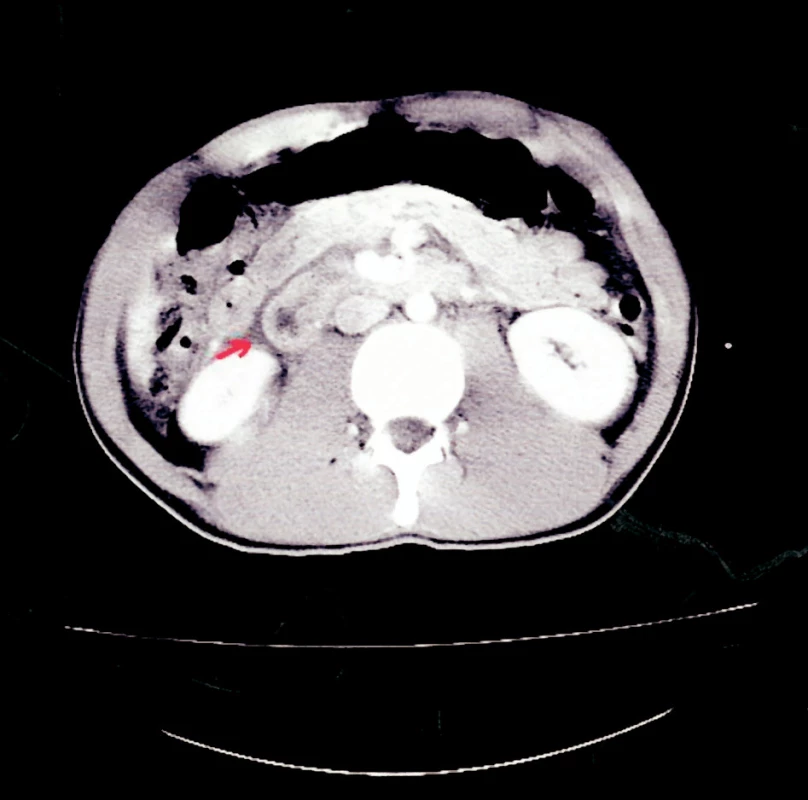 CT snímek – minimální množství tekutiny v hepatorenálním prostoru vpravo
Fig. 1. CT view – a minimum amount of fluid in the right hepatorenal region