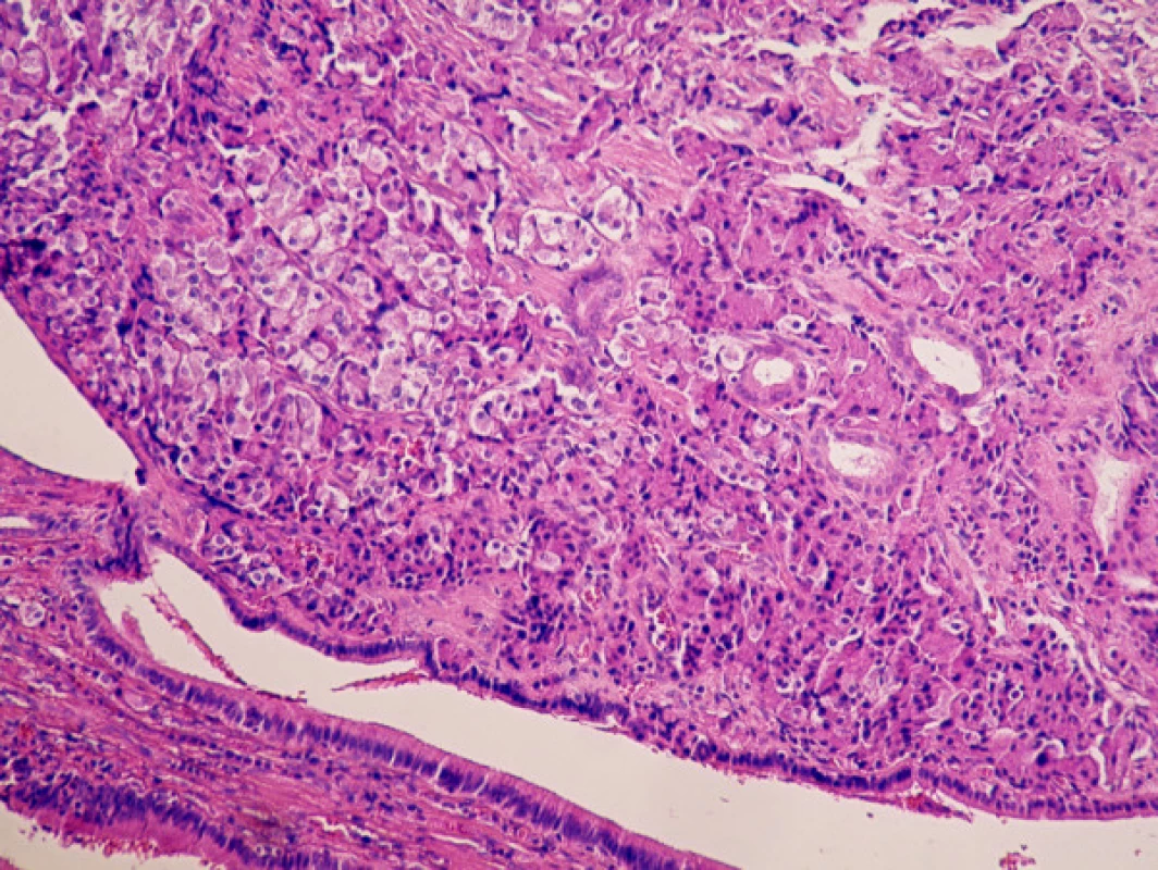 Intaktní kryptovitě formovaný povrchový epitel, intramukózně uložený nádor, redukované žlázy ve stromatu. Dvojí charakter nádorových buněk – světlejší epiteloidní, tmavší endokrinní
Fig. 1. Intact cryptic superficial epithelium, intramucosal tumor, reduced stromal glands. Dual character of the tumor cells – lighter epitheloid, darker endocrine cells