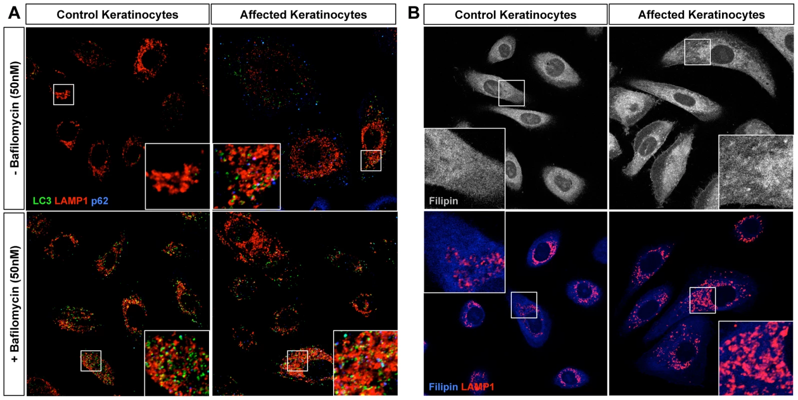 Homozygous loss-of-function of <i>ABCA5</i> perturbs lysosome function, resulting in an overall accumulation of autophagosomes and intracellular cholesterol levels in CGHT keratinocytes.