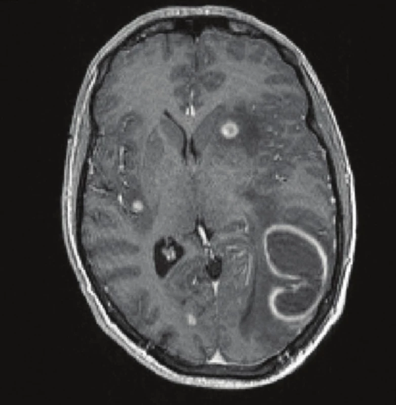 Magnetická rezonance – mnohočetné metastázy maligního melanomu do mozku
Fig. 2: Magnetic resonance imaging – multiple melanoma metastases to the brain