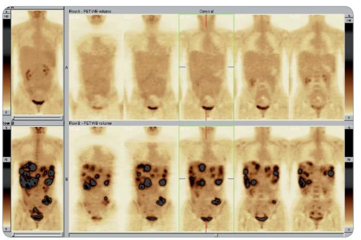 Dosažení PET kompletní remise při terapii imatinibem: dolní řada obrázků – před zahájením léčby: ložiska ve zvětšených játrech, levém mezogastriu a malé pánvi retrovezikálně, ložiska vykazují kumulovanou aktivitu odpovídající metabolismu maligních buněk; horní řada obrázků – po 5 týdnech léčby: kontrolní scan nedetekuje žádná ložiska hypermetabolizmu glukózy svědčící pro přítomnost viabilní nádorové tkáně [31].