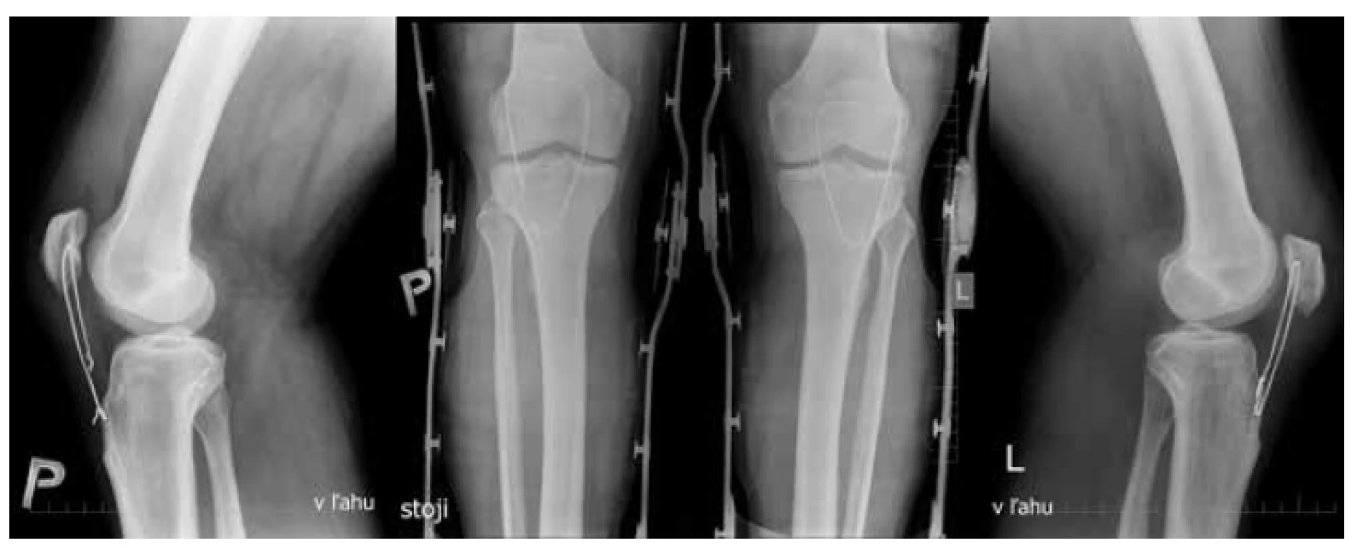 Predozadné a bočné projekcie
oboch kolien 2 týždne po operácii
Rozvlečenie serklážnej slučky pravého kolena
- patella alta (Insall-Salvati ratio=1,38).
Ľavé koleno - patela vo vyhovujúcom postavení
(Insall-Salvati ratio=1,056).<br>
Fig. 2: Anteroposterior and lateral views
of both knees two weeks after surgery
Unravelled wire on the right knee – patella alta
(Insall-Salvati ratio=1.38). Left knee – correct
patellar position (Insall-Salvati ratio=1.056).