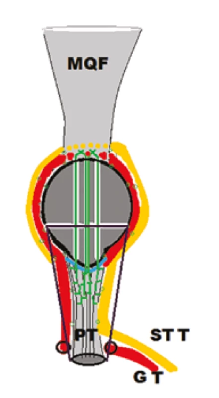 Schématické znázornenie revíznej operácie pre
  re-ruptúru <i>ligamentum patellae</i> s augmentáciou šľachami
  <i>musculus semitendinosus</i>
  (STT − žltá) a <i>musculus gracilis</i> (GT − červená). Transoseálna
reinzercia (zelená) ruptúry (modrá).<br>
  Fig. 3: Schematic illustration of the revision surgery for
patellar tendon re-rupture, using semitendinosus
  (STT − yellow) and gracilis muscle (GT − red) augmentation. Transosseous
suture (green) of the patellar ligament rupture (blue).