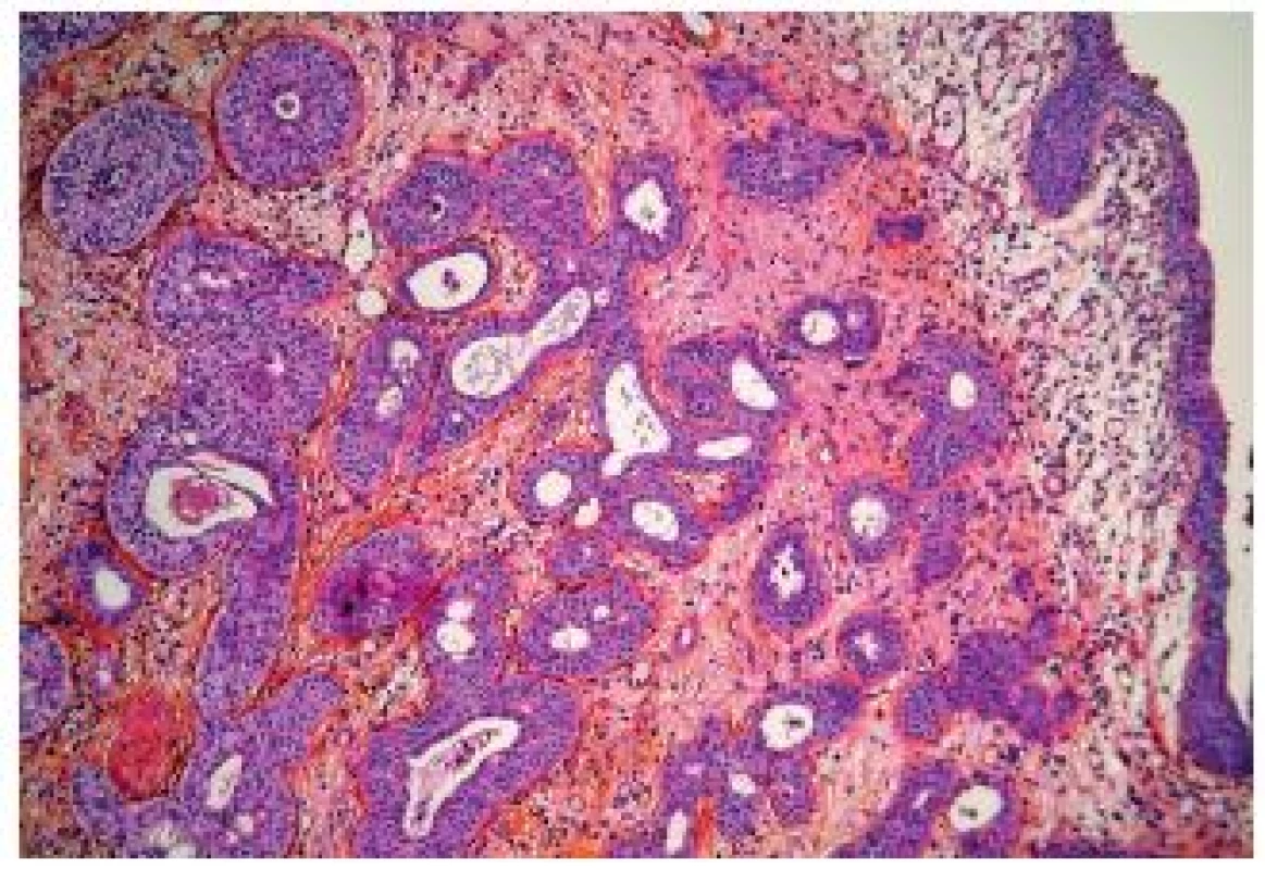 Microcystic variant of UC, well delimited carcinomatous nests infiltrating into the lamina propria.