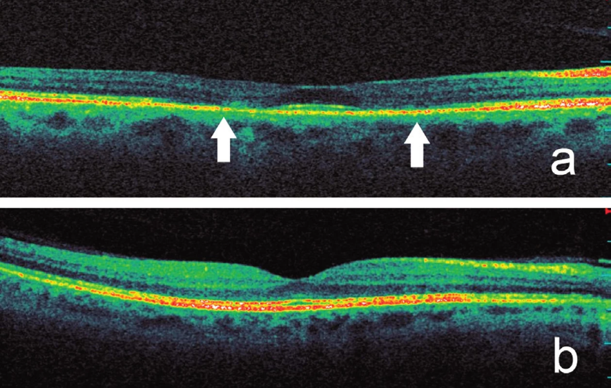 Optická koherenční tomografie se spektrální doménou prokazuje a) pokles výšky zevních vrstev sítnice v mezikruží okolo normální fovey a ztrátu hyperreflexivní linie spojení vnitřních a zevních segmentů fotoreceptorů (označeno šipkami), b) pro srovnání normální SD‑OCT scan makuly