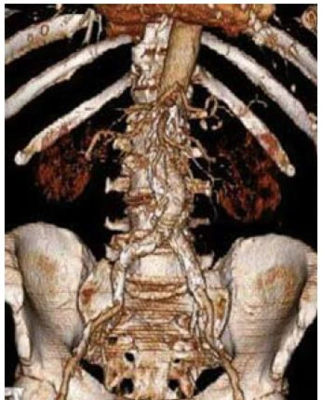 3D CT rekonstrukce obrazu aneuryzmatu břišní aorty po implantaci břišního stentgraftu.