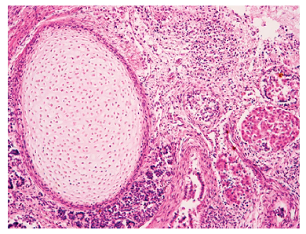 Histological structure of the teratoma. Islet of cartilage in the left part, islet of hepatocytes in the right part, miscellaneous glandular structures in surrounding areas. HE, magnification 200x.