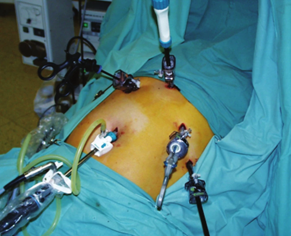 Umístění portů při laparoskopické exstirpaci jícnu