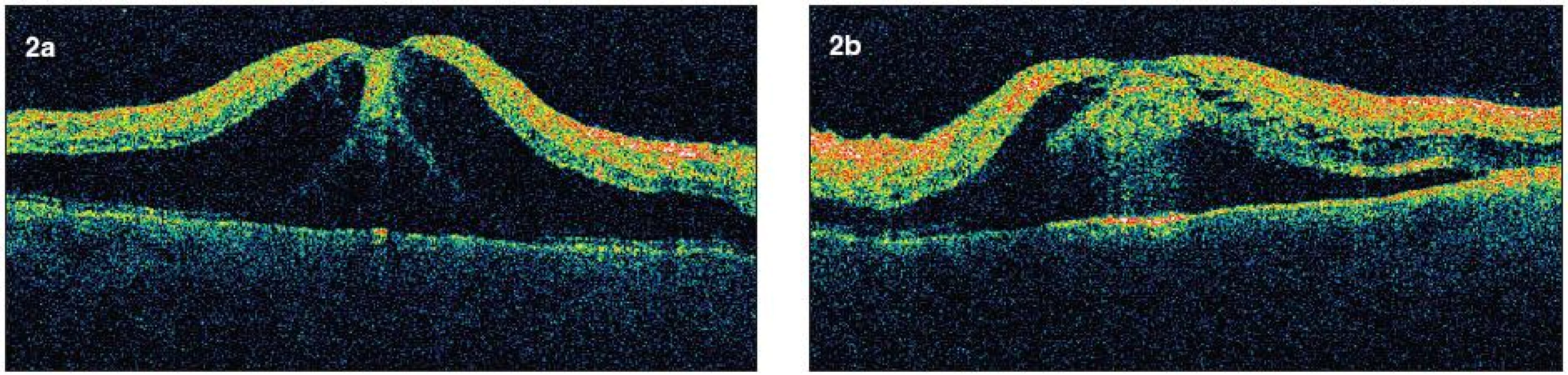 Horizontálne skeny pravé a ľavé oko (OCT III Stratus Zeiss) pred začatím liečby. a, b) Nárast centrálnej hrúbky fovey, v peripapilárnej oblasti v mieste nahromadenia vatovitých ložísk sa nachádzajú výrazne hyperreflektívne oblasti.Tekutina je prítomná intra i subretinálne. Intraretinálne sa nachádzajú cystické priestory nízkej reflektivity. Nahromadenie intraretinálnej tekutiny je evidentné v celej oblasti makuly