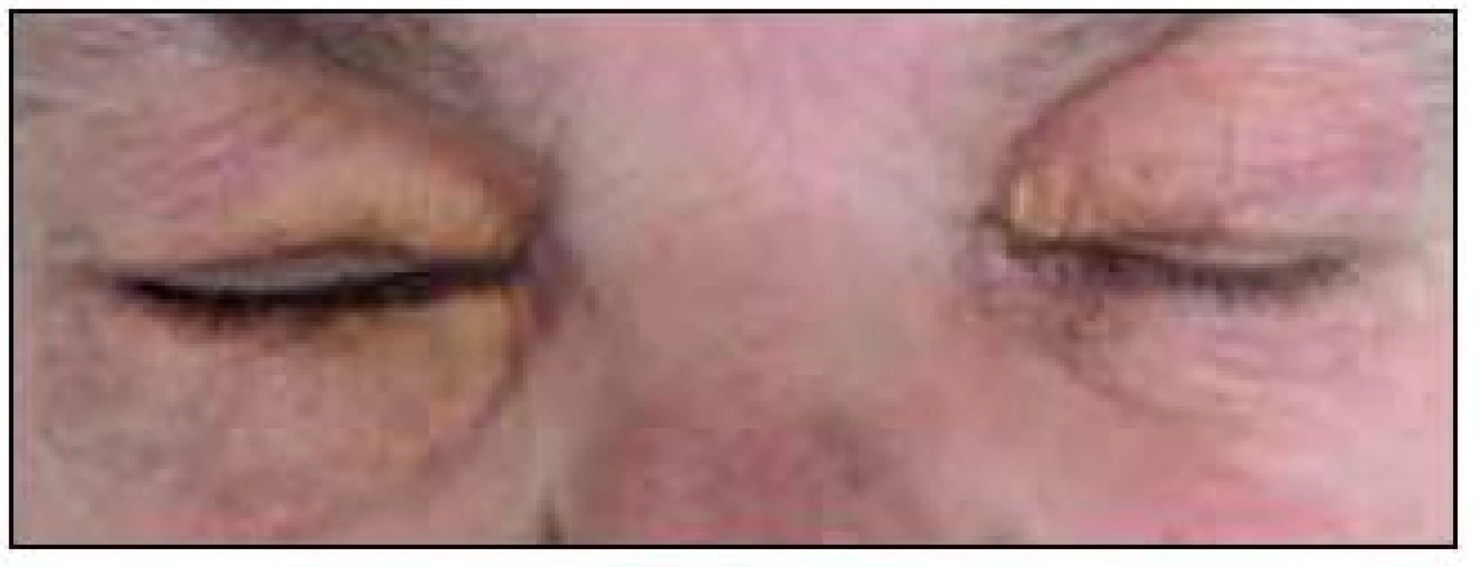 Periokulární xantogranulom. Na rozdíl od případu zobrazeného na obr. 1 zde tvoří xantomové buňky žlutavé granulomy, které však nezůstávající pouze na povrchu kůže, ale zasahují i do nitra orbity, jak ukazuje obr. 3, a mohou zhoršovat zrak.