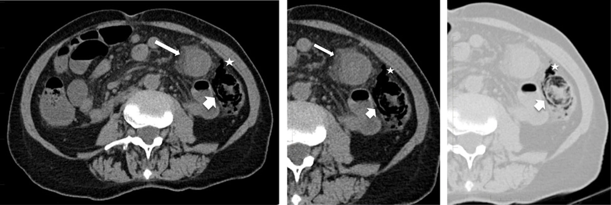 Radiologic images: a Axial view of unenhanced abdominal CT showing thickened bowel wall with fat stranding (thin arrow) involving the colonic splenic flexure. b and c Zoomed axial view of the left abdomen in soft tissue (b) and pulmonary (c) windows showing pneumatosis (thick arrow) and free air in the surrounding mesocolon (star)