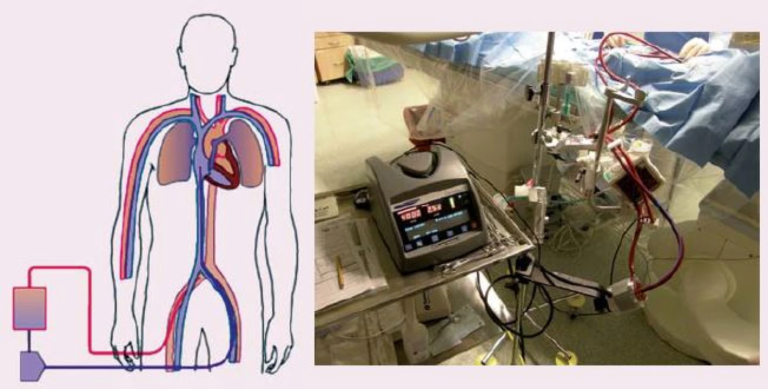 ECLS (extracorporeal life support), schéma zapojení (vlevo), krevní pumpa Levitronix s oxygenátorem (vpravo).