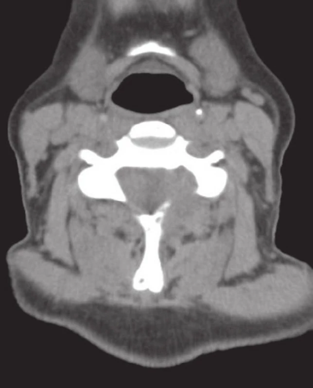 Agresívně rostoucí tumor s pokročilou destrukcí levostranného oblouku obratle C6 a expanzí do extradurálního prostoru páteřního kanálu (MRI).