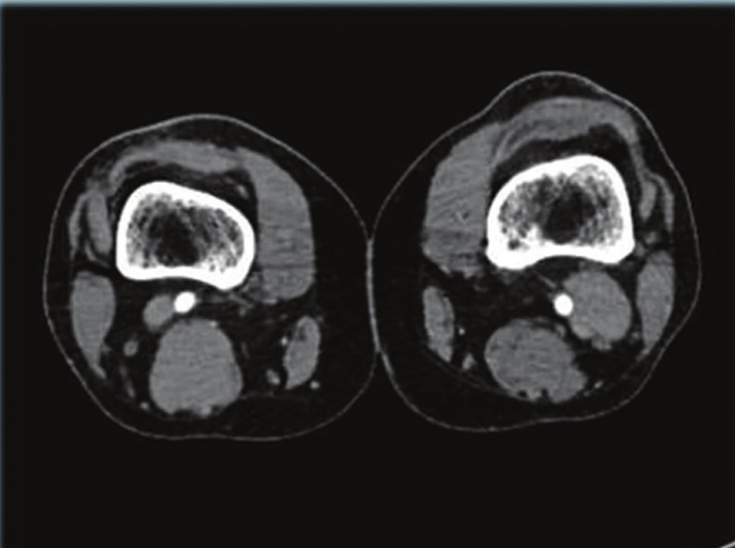 CT AG, patrné aneuryzma vena poplitea vlevo
Fig. 1: CTAG; visible aneurysm of vena poplitea sinistra