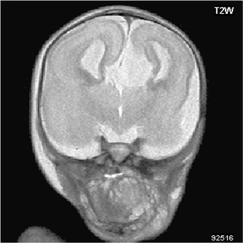 Post mortem MRI vyšetření