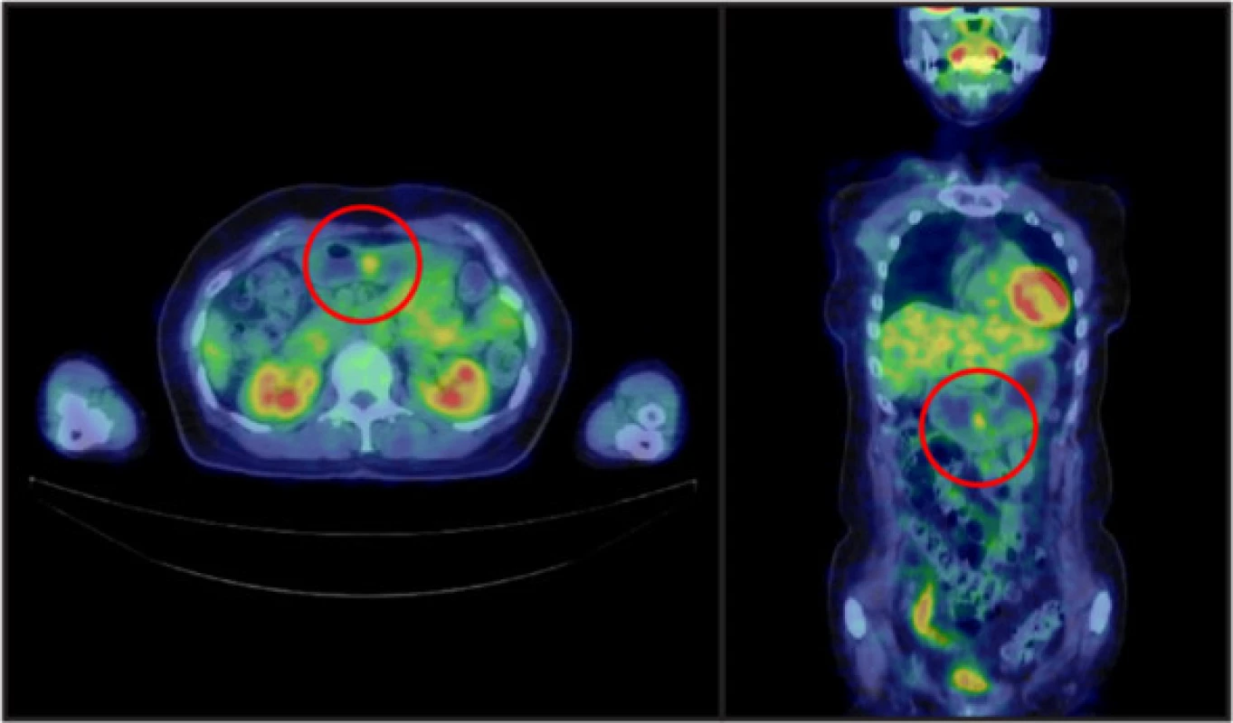Positron emission tomography-computed tomography findings. A well-circumscribed mass was observed in the lower gastric body, with a maximum standardized uptake value of 2.7