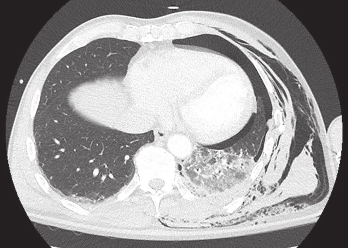 Rozsáhlá plicní kontuze v levém dolním laloku se sdruženým poraněním hrudníku
Fig. 1: Extensive pulmonary contusion in the left lower lobe with chest wall injury