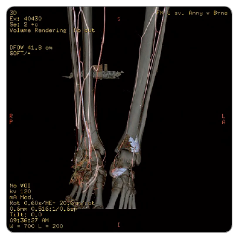 Viditeľná osteolýza pri CT angiologickom vyšetrení pravej nohy.