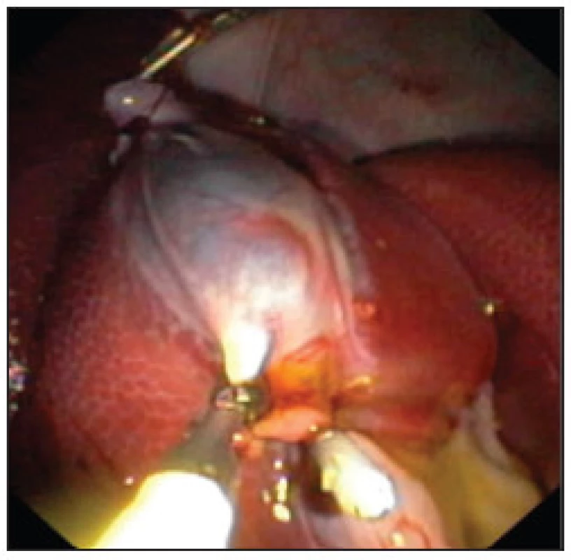 Zaklipování a. a d. cysticus pomocí běžných endoklipů
Fig. 2. Clipping of cystic duct and artery using common endoclips