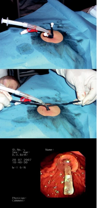 a-c. Zavádění perkutánní endoskopické gastrostomie metodou „push“