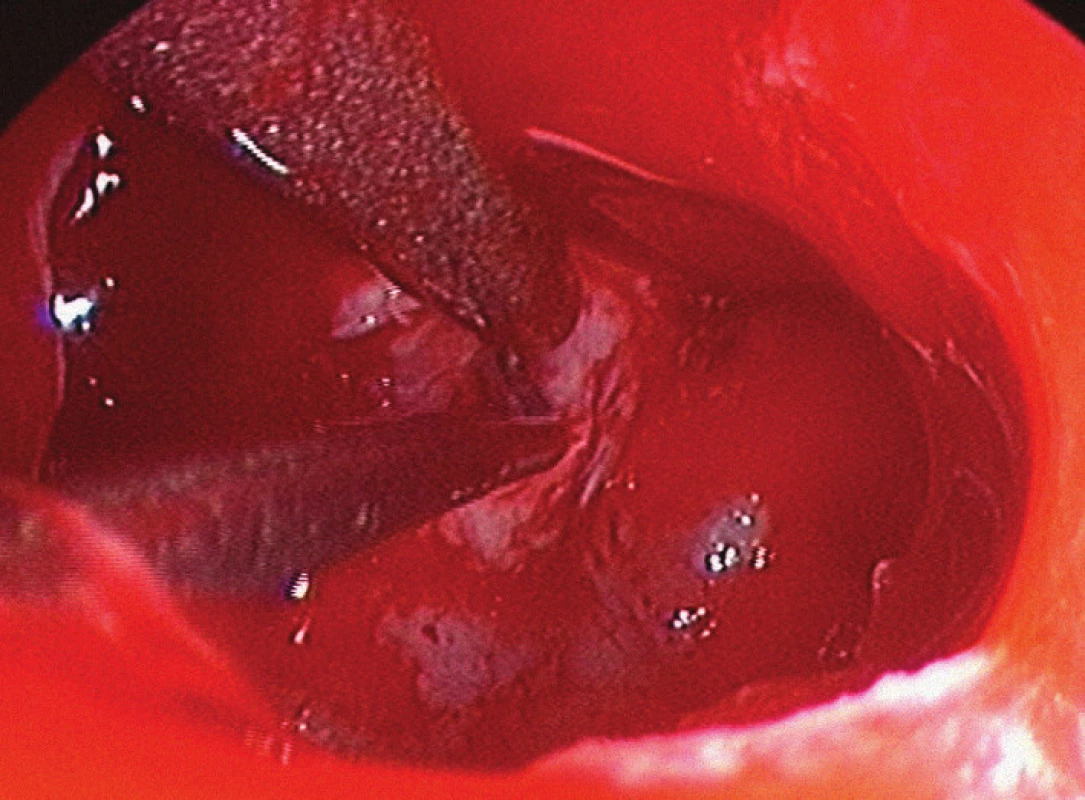 Endoskopický pohled do sfenoidální dutiny, spodina tureckého sedla snesena vysokoobrátkovou frézou, kyretou a sáním je odstraňován adenom hypofýzy.