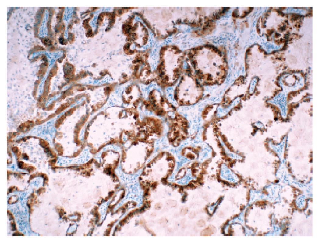 Plicní adenokarcinom s přestavbou ROS1 v imunohistochemickém průkazu pomocí protilátky klonu D4D6.
