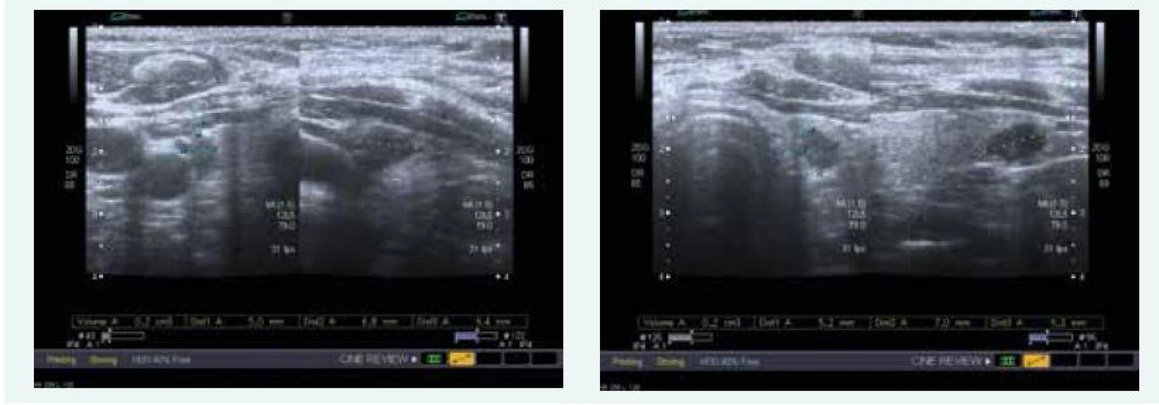 Kazuistika 2 – adenom příštítného tělíska vpravo a vlevo (USG) (snímky v plném rozlišení naleznete v on-line verzi článku)