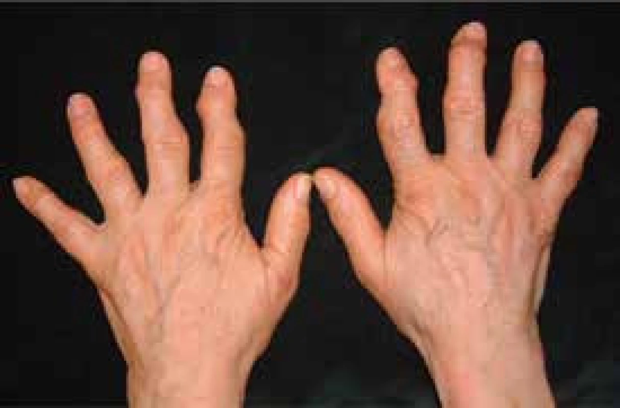 Erozivní osteoartróza rukou