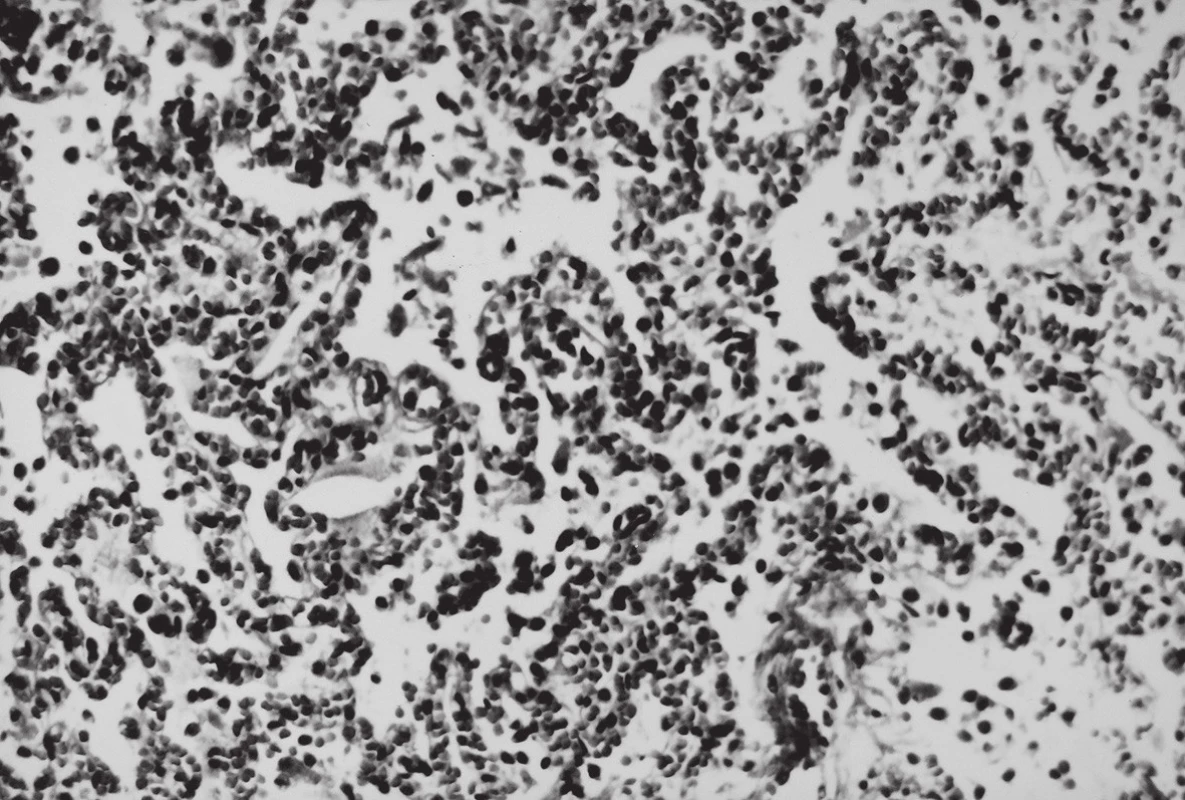 Mikroskopický obraz pľúcneho tkaniva po evakuácii alveolárneho vzduchu; HE, 200x.