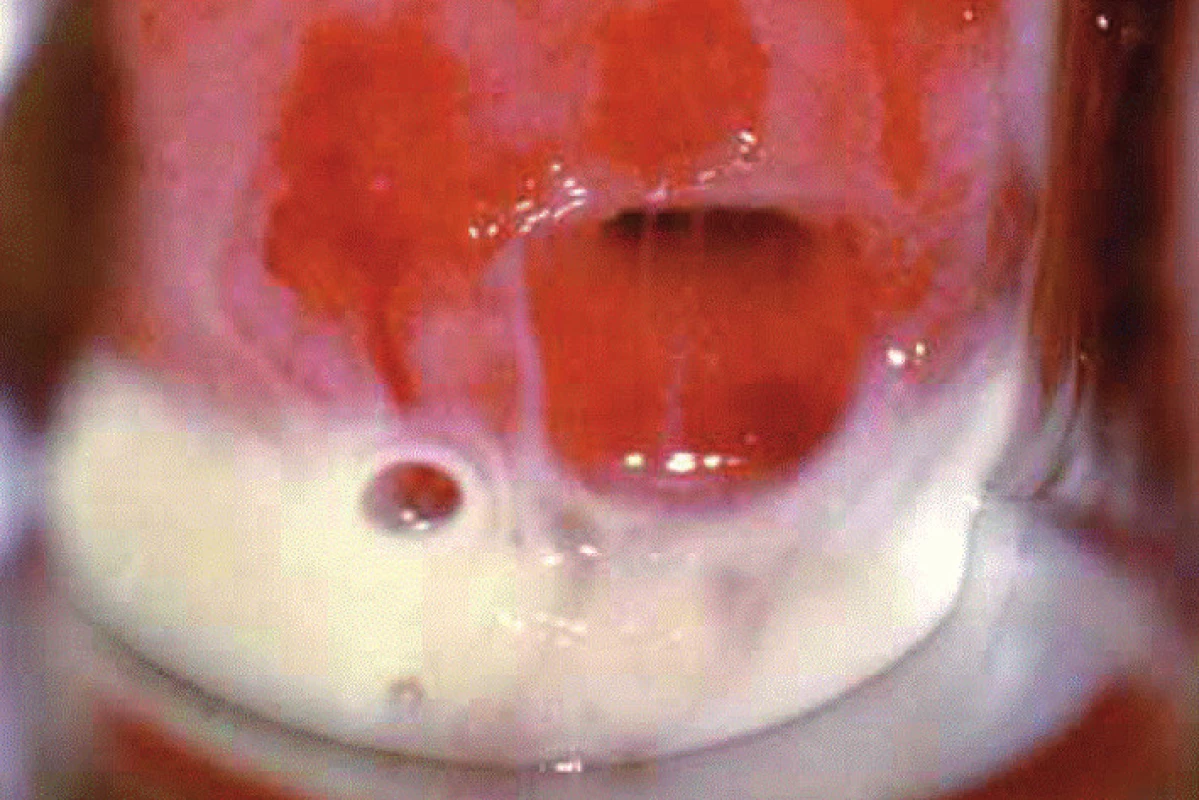 Hojný homogenní ulpívající vaginální fluor při BV. Snímek laskavě zapůjčil prof. Giovanni Miniello, Bari, Itálie.