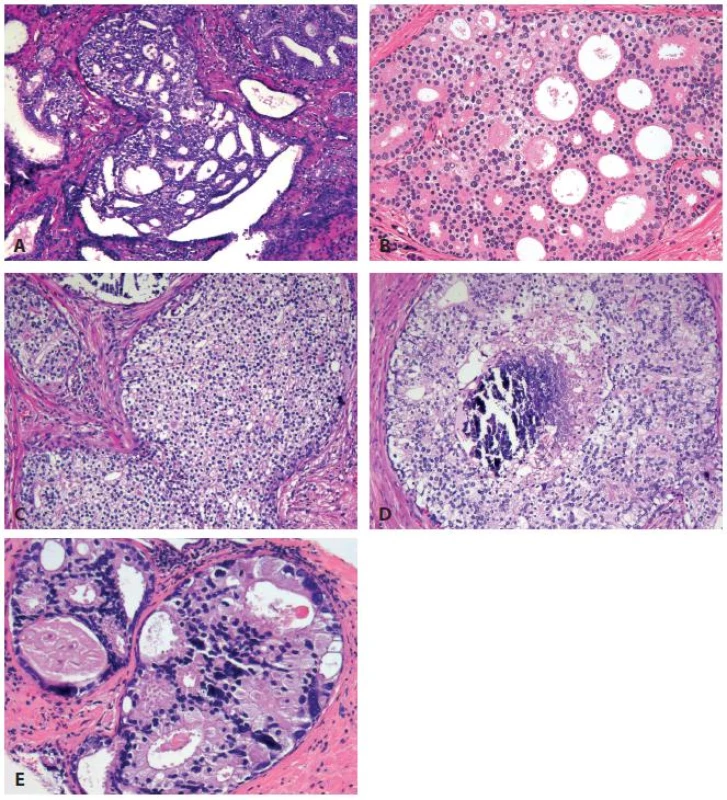 Histological features of intraductal carcinoma of the prostate (IDC-P) include loose cribriform (A), dense cribriform (B), solid growth (C) patterns. Comedonecrosis (D) and marked nuclear pleomorphism with nuclear size &gt;6× of the adjacent non-neoplastic cells (E) are present in some, but not all, the cases. Of these morphological features, dense cribriform and solid patterns, non-focal comedonecrosis, and marked pleomorphic nuclei are diagnostic of IDC-P.