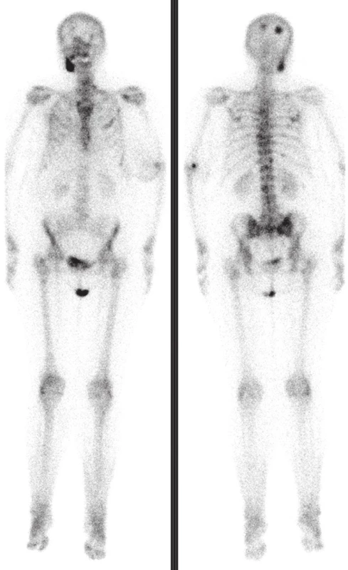 Kontrolní scintigrafie provedená půl roku po skončení radioterapie prokazuje výraznou progresi patologických ložisek zvýšené kostní přestavby v celém skeletu, nejvýrazněji v lebce, v bederní páteři a v pánvi. Nález byl hodnocen jako výrazná progrese. V léčbě byl přidán denosumab (XGEVA), vzhledem k nekróze čelisti však byla podána jediná injekce.