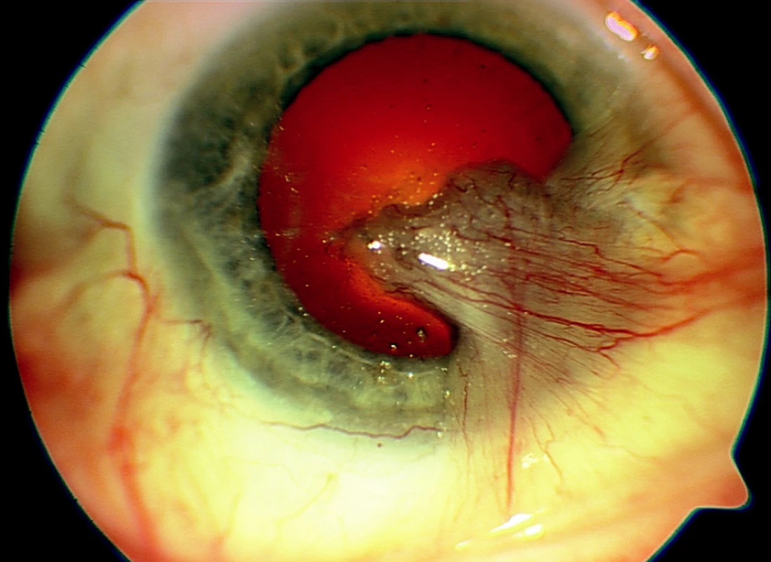 Pravé oko – recidiva po 4 operacích