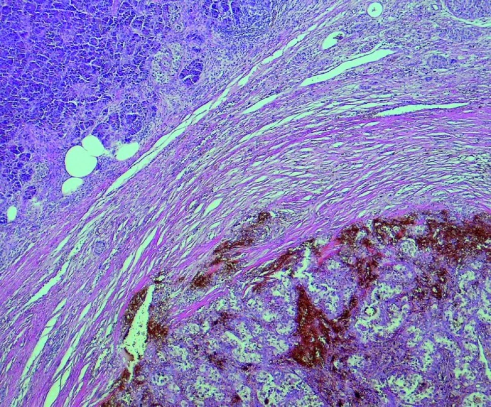 Metastáza karcinomu ledviny v pankreatu; prokrvácený nádor je vpravo dole.
Barvení H&amp;E, zvětšeno 4krát.